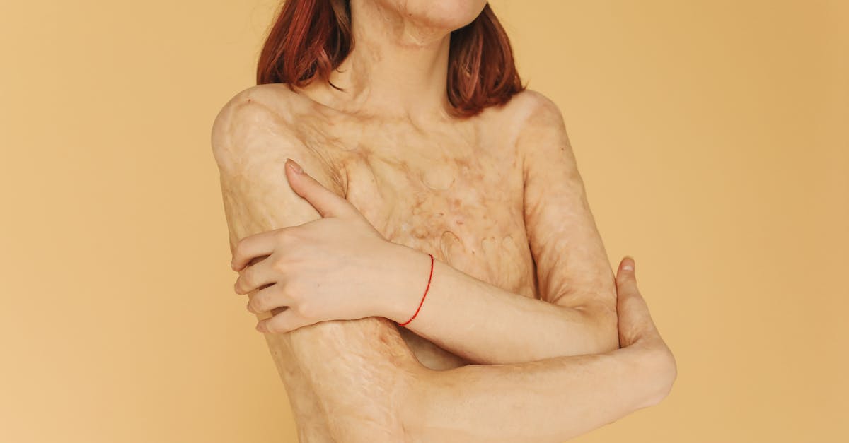 les troubles somatoformes sont des conditions où des symptômes physiques sévères apparaissent sans cause médicale identifiable, nécessitant une approche clinique multidisciplinaire pour un diagnostic et un traitement appropriés.